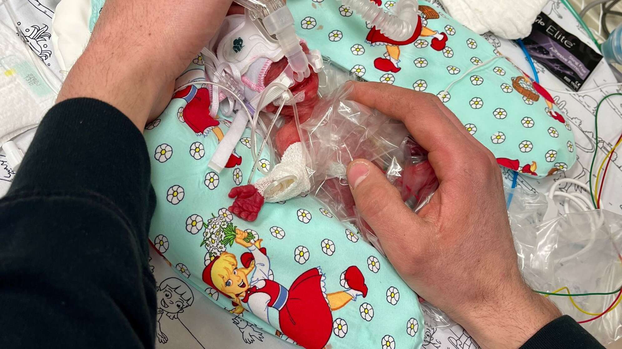 Frühgeborenes Mädchen mit 265 Gramm in Passau zur Welt gekommen