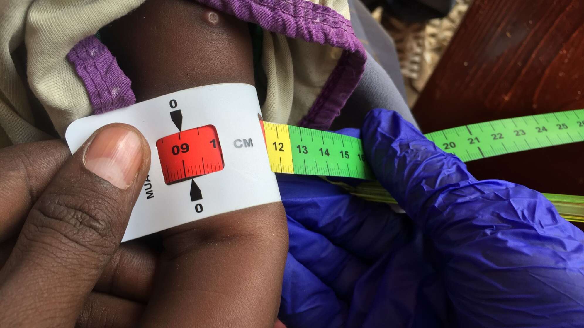 Ein Arzt misst den Armumfang eines unterernährten Babys.