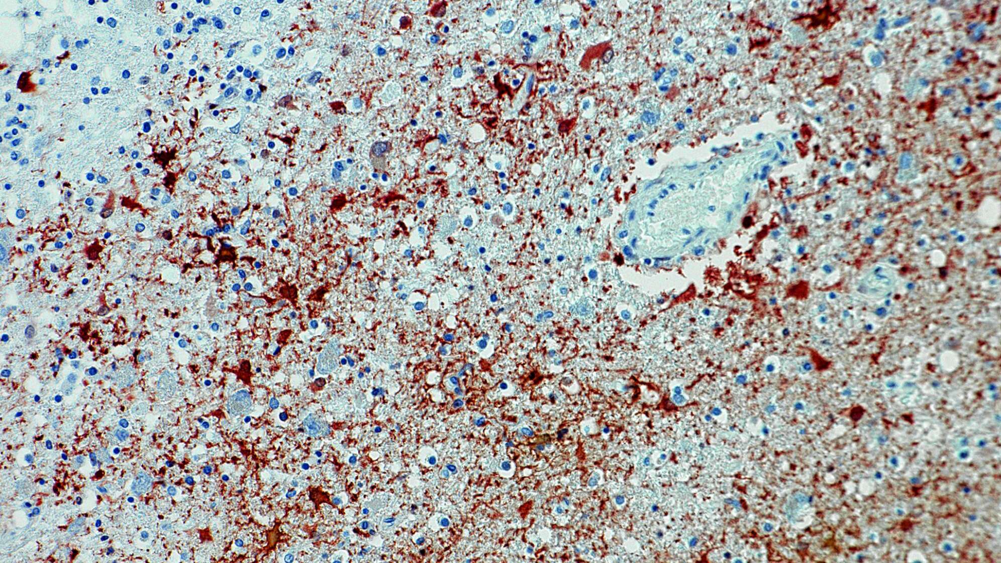 Tödlicher Borna-Virus - Antikörpernachweis im Gewebe